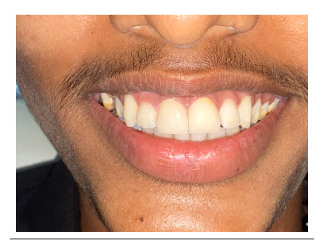 Patient's smile - 
